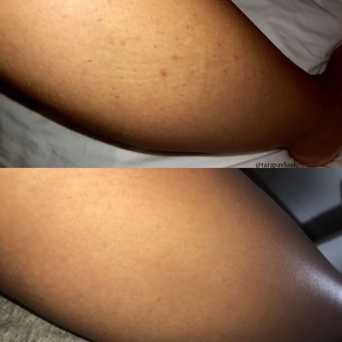 Get rid of ingrown hairs FAST - Eco By Sonya Europe
